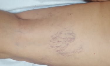 sclerozari vanectazii si varice timisoara