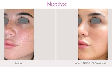 skin smoothing and texture improvement after professional treatment in Hamilton clinic
