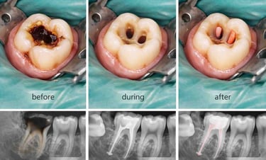 multi root treatment 
