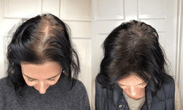 Best Scalp Micropigmentation in Toronto