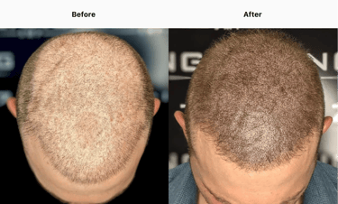 Best Scalp Micropigmentation Toronto_ATRUBARBER