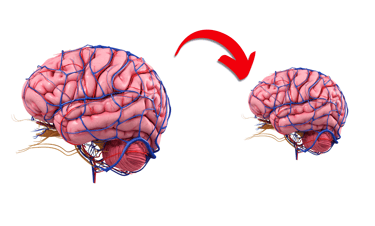 Illustration of a normal-sized brain on the left and an arrow pointing to a smaller brain.