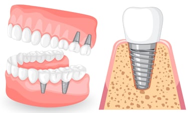 Avantages des implants dentaires hygiene-precision.com