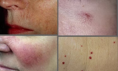 tratament IPl cuperoza, pete brune