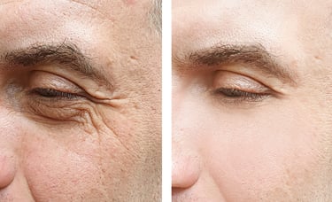 Botox Before and After