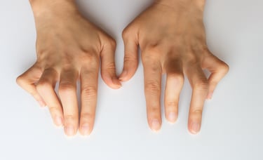   Hands with joint stiffness, deformity on hands and visible inflammation due to RA.