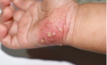 infeksi kulit bernanah