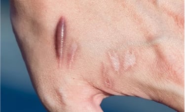 scar kemerahan pada kulit