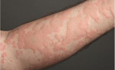 penyakit kulit gatal dan kemerahan