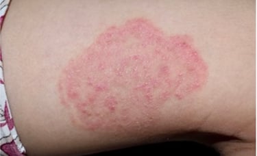 infeksi kulit ruam kemerahan