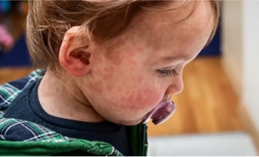 penyakit kulit kemerahan