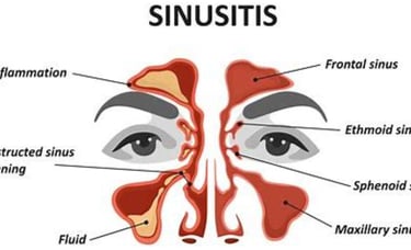 sinusitis