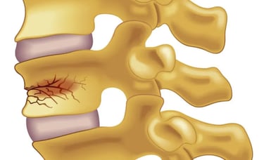 Dr.Rajinikanth's ortho clinic spine fracture