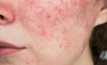 Da bị burn-out do lạm dụng treatment