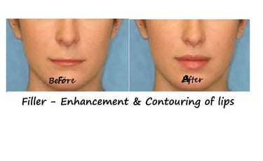 Före- och efterbild filler läppar – ökad volym, tydligare kontur och slät hud runt munnen