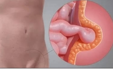 Imagem ilustrativa Hérnia Inguinal