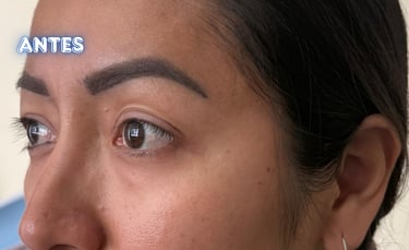Dra.LilyanMarissel-Cirugía Plástica-Estética - blefaroplastia-transconjuntival-resultados-naturales