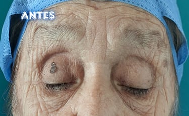 Dra. Lilyan Marissel - Cirugía Plástica y Estética - blefaroplastia-superior-adulto-mayor-cantopexia