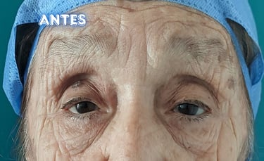 Dra. Lilyan Marissel - Cirugía Plástica y Estética - blefaroplastia-superior-adulto-mayor-cantopexia