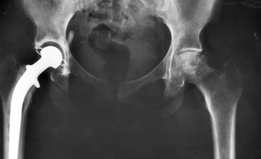 Dr.Rajinikanth's ortho clinic Hip joint infection