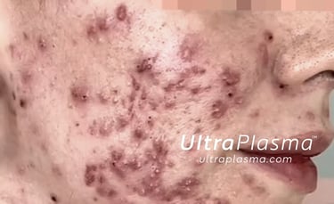 akne_acne_ultra_plasma_ultra_plazma_ultra-plasma_ultra-plazma