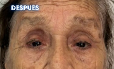 Dra. Lilyan Marissel - Cirugía Plástica y Estética - blefaroplastia-superior-adulto-mayor-cantopexia