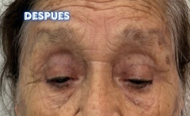 Dra. Lilyan Marissel - Cirugía Plástica y Estética - blefaroplastia-superior-adulto-mayor-cantopexia