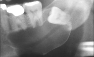 cisto dentígero  resumo patologia oral para concurso público de odontologia patologia bucal