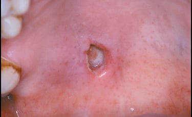 patologias de glândulas salivares resumo patologia bucal sialometaplasia necrosante