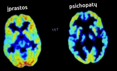 Smegenų nuskenuotas paveiklas, palyginantis psichopato ir normalias smegenis. Normalios ryškios.