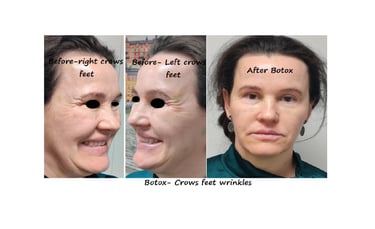 Före- och efterbilder av botox runt ögonen – slätare hud och yngre utseende.