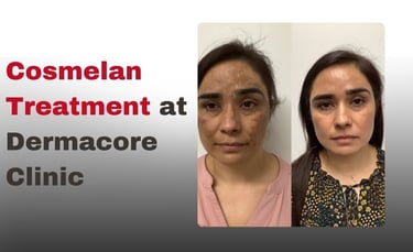 Cosmelan Treatment