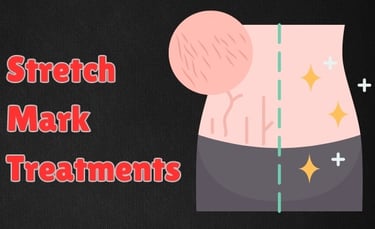 Stretch Mark Treatments