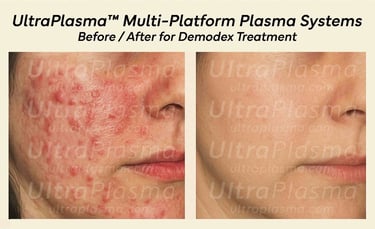 demodex_tedavi_treatment_ultra_plasma_ultra_plazma_ultra-plasma_ultra-plazma