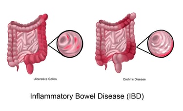 inflammatory bowel disease GASTRO FOUNDATION