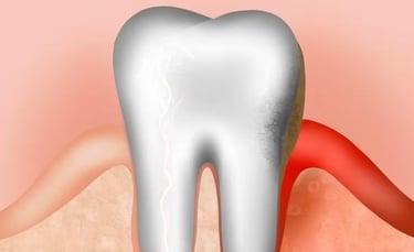 Ozone pour soigner les tissus de soutien des dents hygiene-precision.com