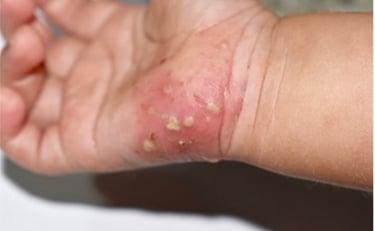 infeksi kulit bernanah