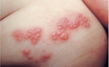 infeksi kulit gatal dan bintik kemerahan