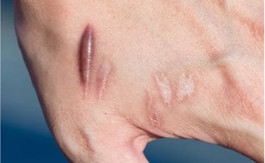 scar kemerahan pada kulit