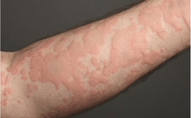 penyakit kulit gatal dan kemerahan