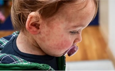 penyakit kulit kemerahan