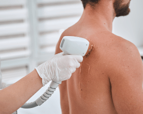 Homme recevant une Épilation laser du dos