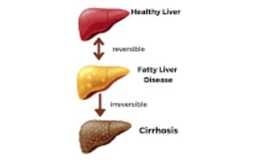 stages of fatty liver diseases