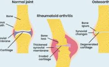 Early Stages of Rheumatoid Arthritis (RA)