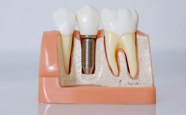 Implantes de carga inmediata en Sevilla