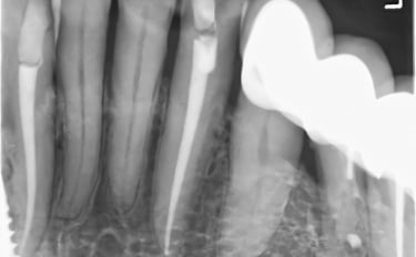 tratament canal dinti timisoara