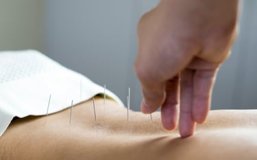Une séance d'acupuncture, sur le dos