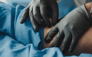 Acupuncture and Dry Needling for Pain Relief at Home
