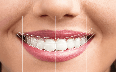 Dental Smile Design Treatment in Wadgaon sheri