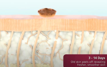 fractional skin resurfacing laser